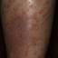 41. Eczema on Shin Pictures