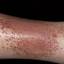 44. Eczema on Shin Pictures