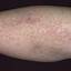 45. Eczema on Shin Pictures