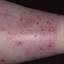47. Eczema on Shin Pictures