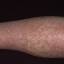5. Eczema on Shin Pictures