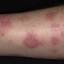 52. Eczema on Shin Pictures