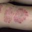 53. Eczema on Shin Pictures