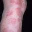 55. Eczema on Shin Pictures