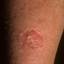 57. Eczema on Shin Pictures