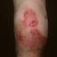 59. Eczema on Shin Pictures