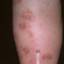 60. Eczema on Shin Pictures