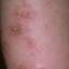 61. Eczema on Shin Pictures