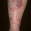 62. Eczema on Shin Pictures