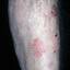 65. Eczema on Shin Pictures