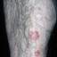 68. Eczema on Shin Pictures