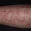 7. Eczema on Shin Pictures