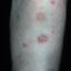 71. Eczema on Shin Pictures