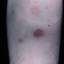 72. Eczema on Shin Pictures