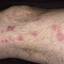 76. Eczema on Shin Pictures