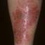 78. Eczema on Shin Pictures