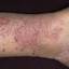 8. Eczema on Shin Pictures
