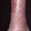 80. Eczema on Shin Pictures