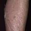 81. Eczema on Shin Pictures