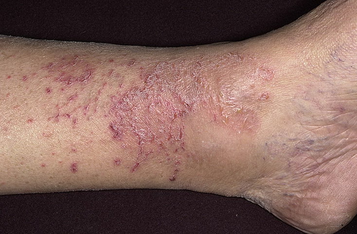 Eczema on Shin Pictures – 81 Photos & Images / illnessee.com