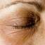 1. Eczema of the Eyes Pictures