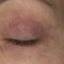 11. Eczema of the Eyes Pictures