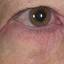 12. Eczema of the Eyes Pictures