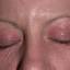 14. Eczema of the Eyes Pictures
