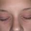 15. Eczema of the Eyes Pictures