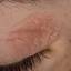 17. Eczema of the Eyes Pictures