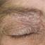 2. Eczema of the Eyes Pictures