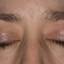 3. Eczema of the Eyes Pictures