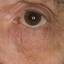 6. Eczema of the Eyes Pictures