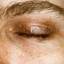 7. Eczema of the Eyes Pictures