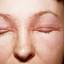 9. Eczema of the Eyes Pictures
