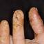 10. Eczema Between Fingers Pictures