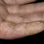 103. Eczema Between Fingers Pictures