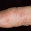 105. Eczema Between Fingers Pictures