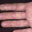 11. Eczema Between Fingers Pictures