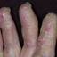 13. Eczema Between Fingers Pictures