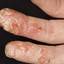 14. Eczema Between Fingers Pictures