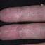15. Eczema Between Fingers Pictures
