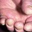 16. Eczema Between Fingers Pictures