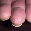 17. Eczema Between Fingers Pictures