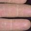18. Eczema Between Fingers Pictures