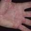 19. Eczema Between Fingers Pictures