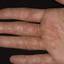 21. Eczema Between Fingers Pictures