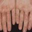 22. Eczema Between Fingers Pictures