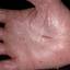 27. Eczema Between Fingers Pictures
