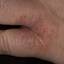28. Eczema Between Fingers Pictures